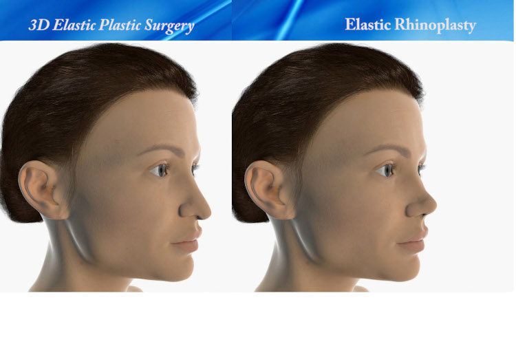 Elastic Rhinoplasty result